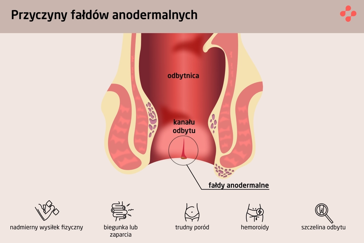 Przyczyny powstawania fałd brzeżnych odbytu