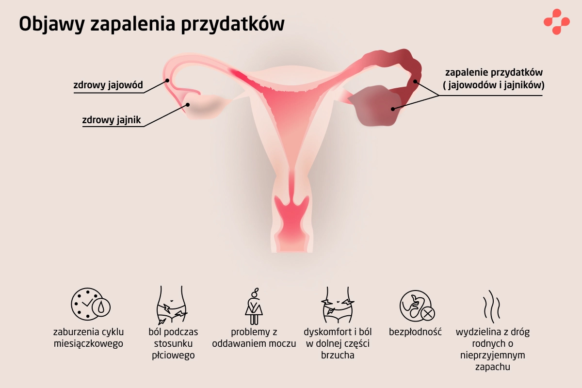 Objawy zapalenia przydatków