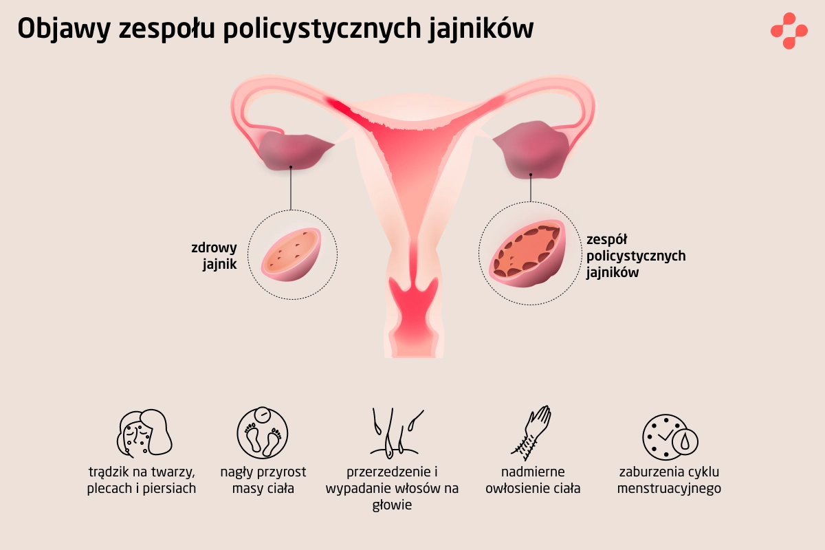 Objawy policystycznych jajników