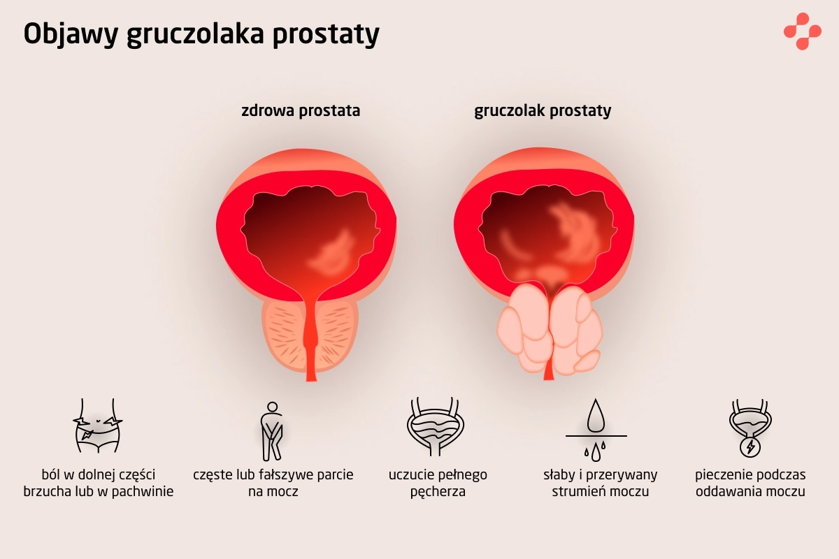 Objawy przerostu gruczołu krokowego