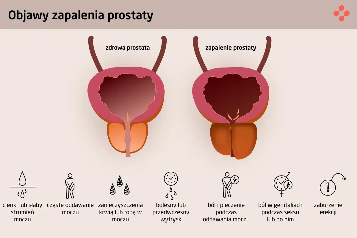 Objawy zapalenia prostaty