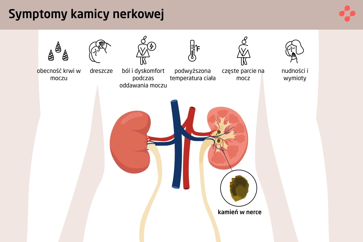 Objawy kamicy nerkowej