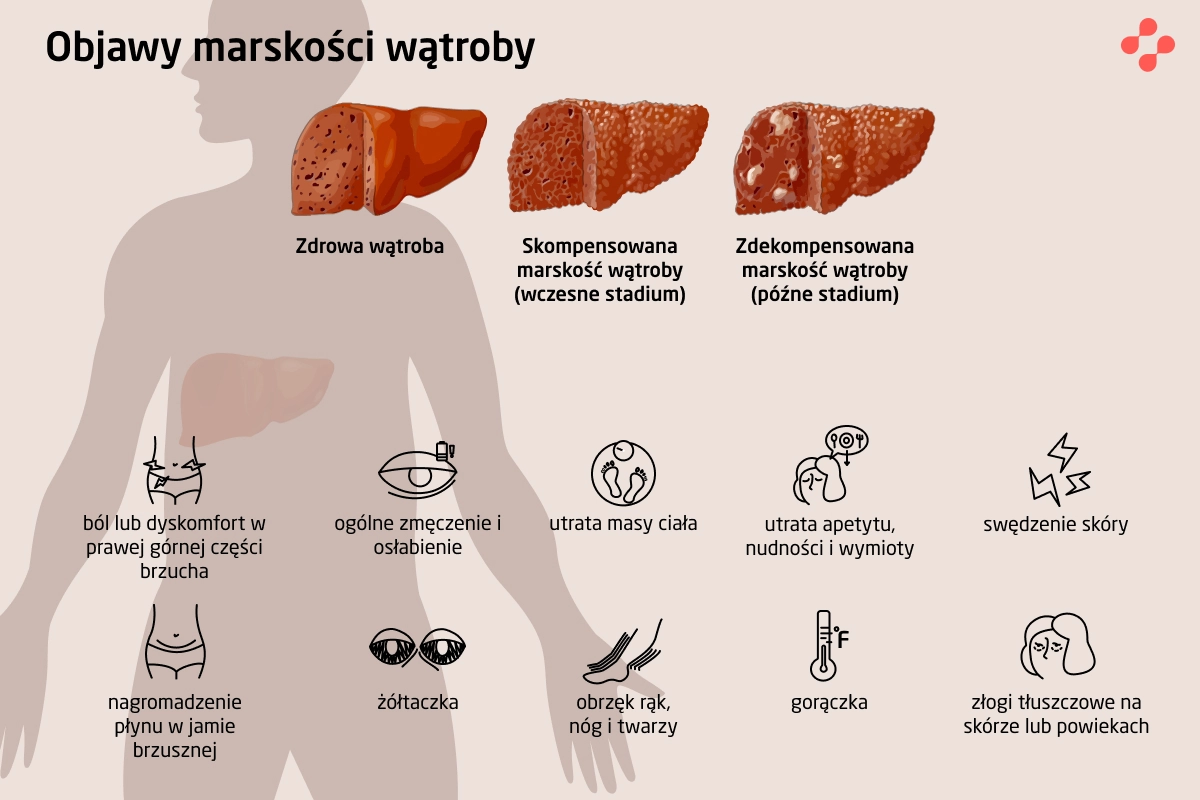 Objawy marskości wątroby