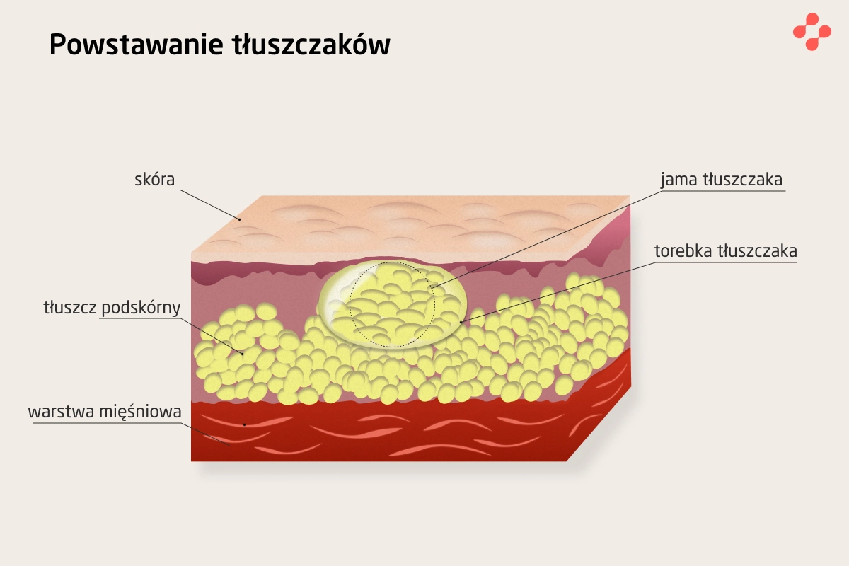 Powstawanie tłuszczaków