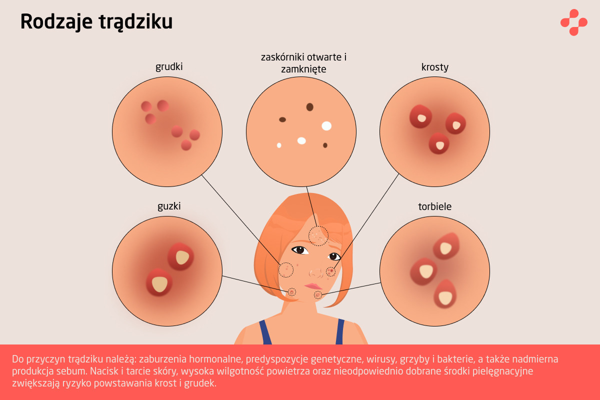 Rodzaje trądziku