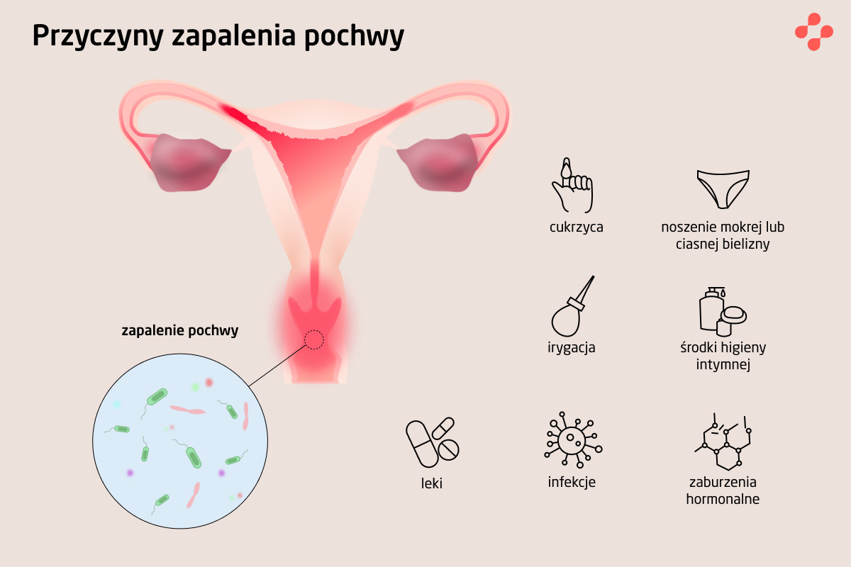 Przyczyny zapalenia pochwy