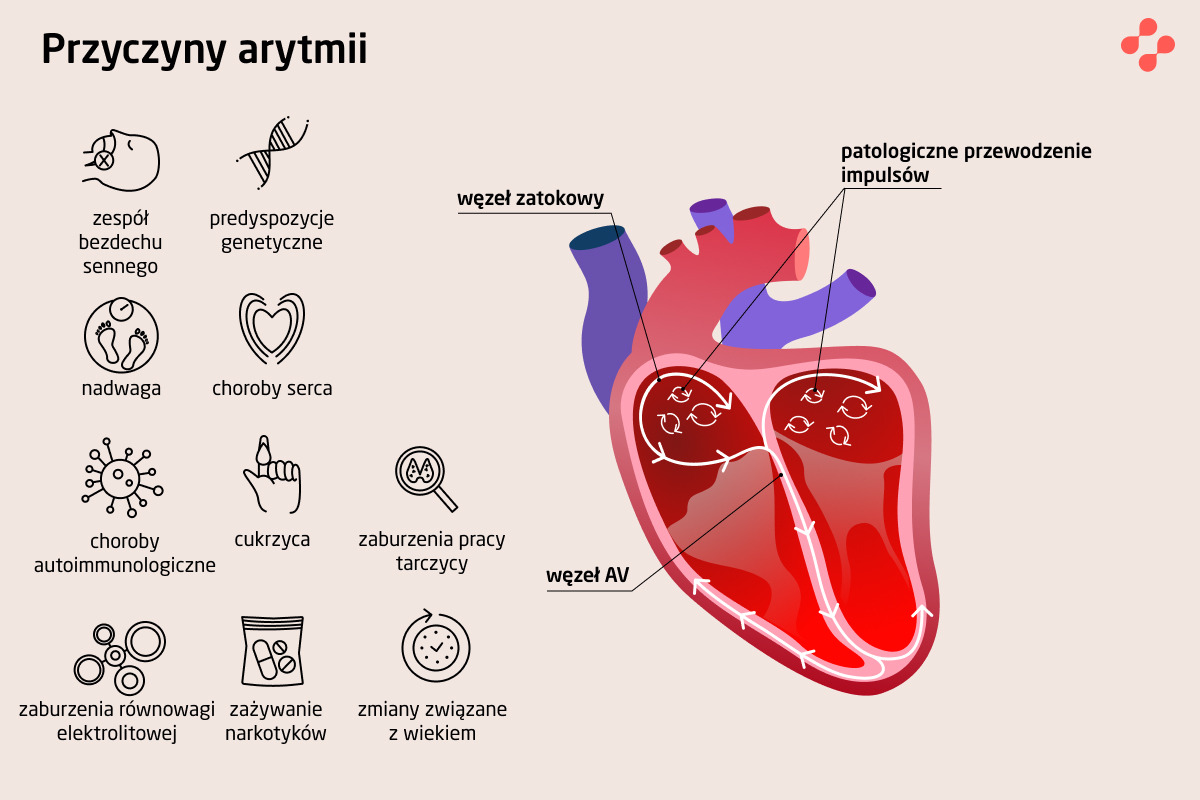 Przyczyny arytmii