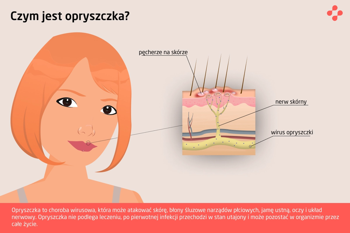 Czym jest opryszczka?