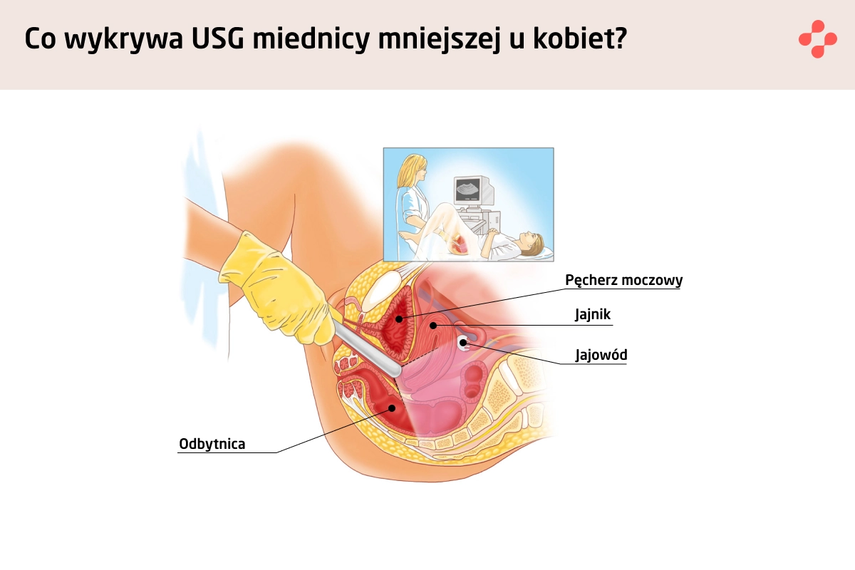 Co wykrywa USG miednicy mniejszej u kobiet?