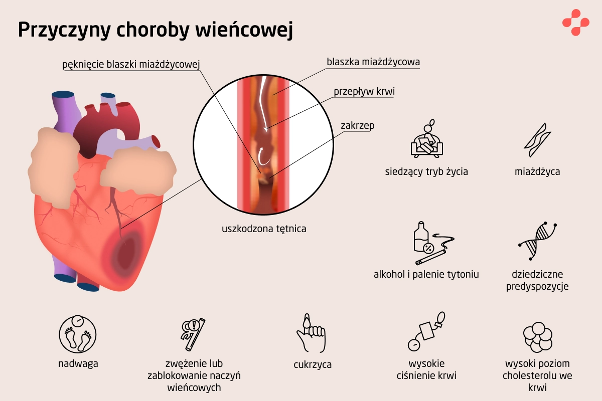 Przyczyny choroby wieńcowej