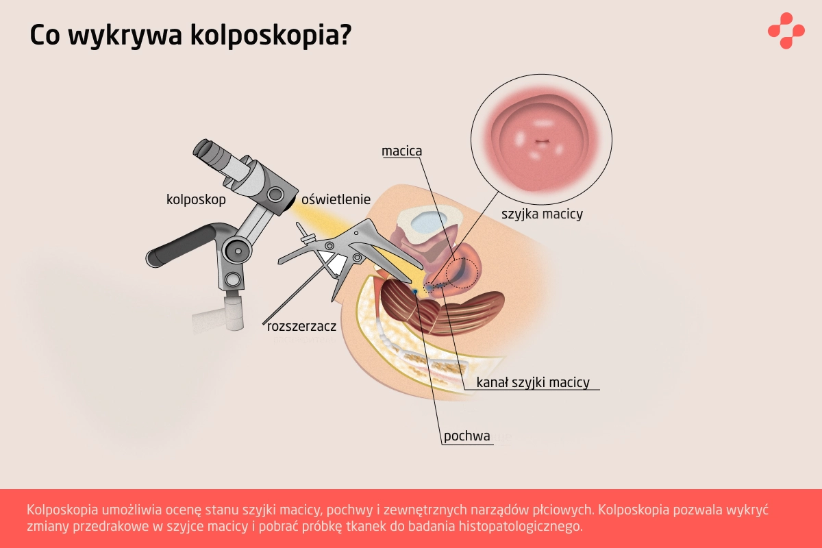 Co wykrywa kolposkopia?