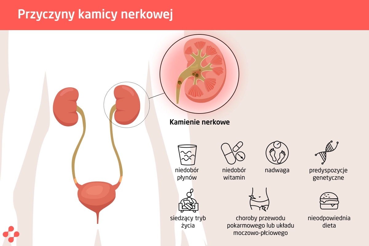 Przyczyny kamicy nerkowej