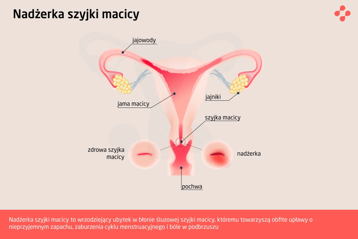 Nadżerka szyjki macicy